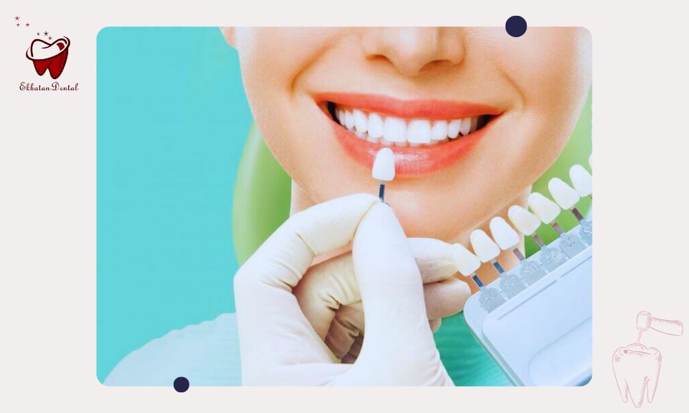تفاوت‌های لمینت و کامپوزیت دندان