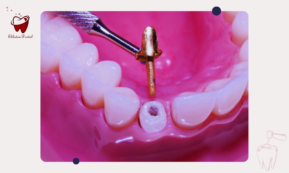 چه زمانی میله داخل ریشه انتخاب بهتری است؟